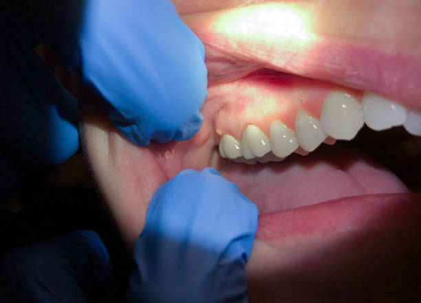 Best Emergency Root Canal Treatment in Mcconnelsville, OH